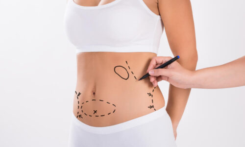 Combining Liposuction with Other Procedures in Dubai