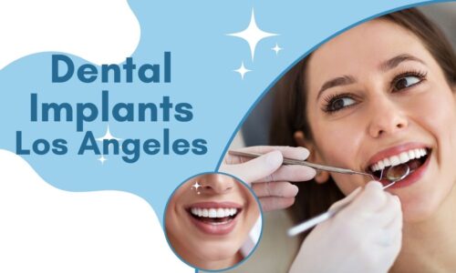 How Long Does It Take Until I Get My Dental Implants in Los Angeles?