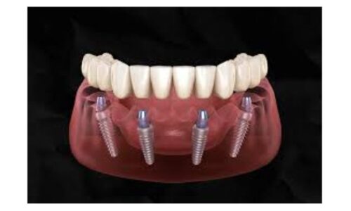 Are All on 4 Dental Implants Right for You? Find Out Now